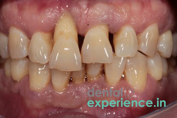 Extruded tooth